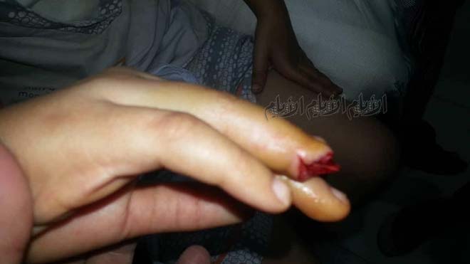 اصبع الطفلة بعد إصابتها وقبل خضوعها للعملية